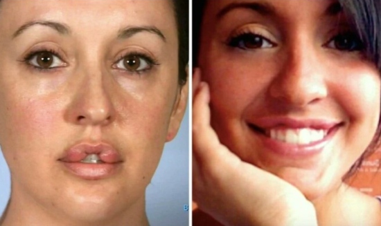 Catherine Reitman Botched Plastic Surgery - Catherine Reitman Lips.